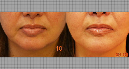 Lip Rejuvenation Before and After Photo by Andrew Kornstein MD in Greenwich, CT and White Plains, NY.