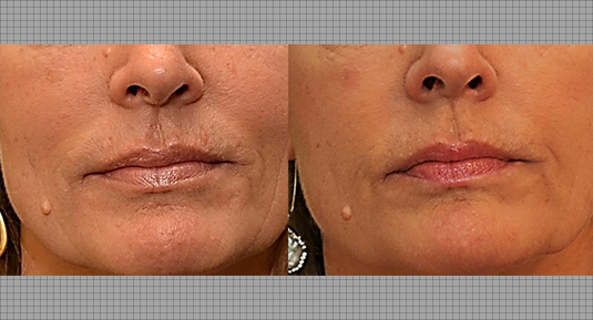Lip Rejuvenation Before and After Photo by Andrew Kornstein MD in Greenwich, CT and White Plains, NY.