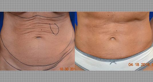 J-Plasma Before and After Photo by Andrew Kornstein MD in Greenwich, CT and White Plains, NY.