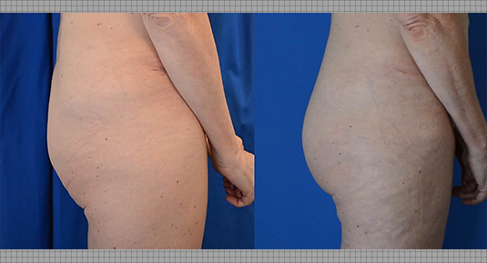 J-Plasma Before and After Photo by Andrew Kornstein MD in Greenwich, CT and White Plains, NY.