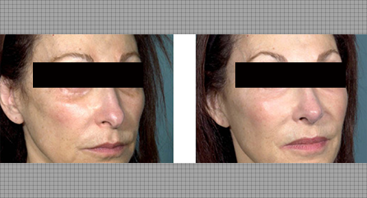 Rhinoplasty Before and After Photo by Andrew Kornstein MD in Greenwich, CT and White Plains, NY.