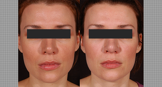 Rhinoplasty Before and After Photo by Andrew Kornstein MD in Greenwich, CT and White Plains, NY.