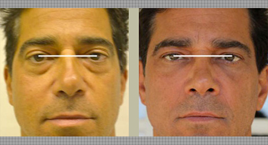 Fat Grafting Before and After Photo by Andrew Kornstein MD in Greenwich, CT and White Plains, NY.