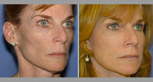 Fat Grafting Before and After Photo by Andrew Kornstein MD in Greenwich, CT and White Plains, NY.