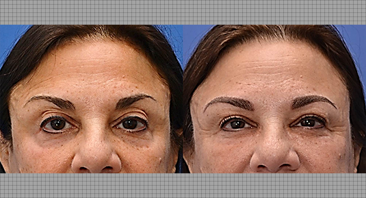 Brow Lift Before and After Photo by Andrew Kornstein MD in Greenwich, CT and White Plains, NY.