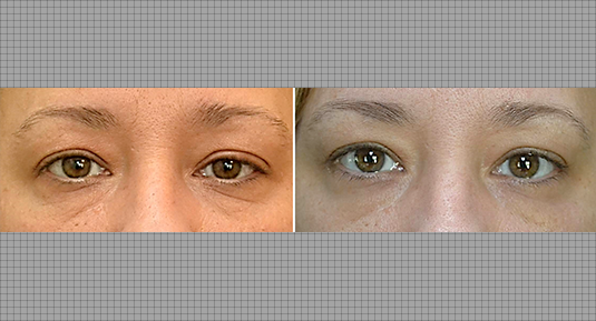 Brow Lift Before and After Photo by Andrew Kornstein MD in Greenwich, CT and White Plains, NY.