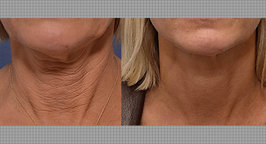 Neck Lift Before and After Photo by Andrew Kornstein MD in Greenwich, CT and White Plains, NY.