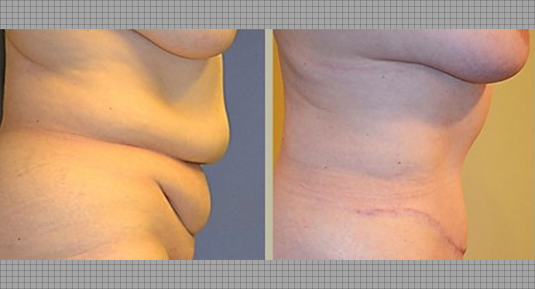 Abdominoplasty Before and After Photo by Andrew Kornstein MD in Greenwich, CT and White Plains, NY.