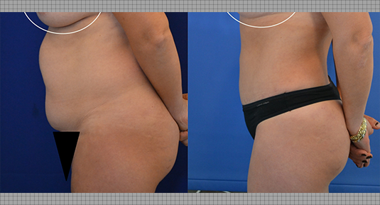 Abdominoplasty Before and After Photo by Andrew Kornstein MD in Greenwich, CT and White Plains, NY.