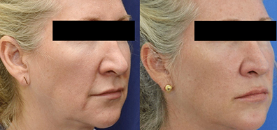 images of before and after photos of real patients of Dr. Kornstein