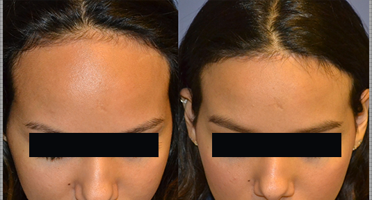 Hairline Lowering Before and After Photo by Andrew Kornstein MD in Greenwich, CT and White Plains, NY.