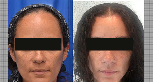 Hairline Lowering Before and After Photo by Andrew Kornstein MD in Greenwich, CT and White Plains, NY.