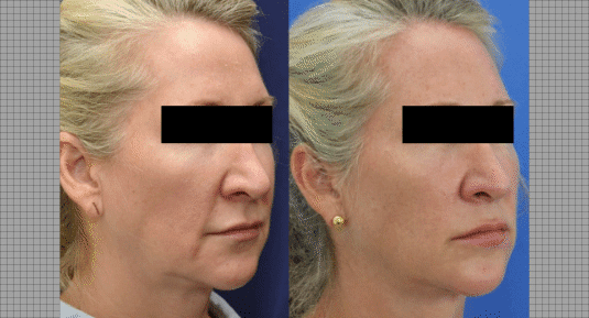 Face Lift Before and After Photo by Andrew Kornstein MD in Greenwich, CT and White Plains, NY.