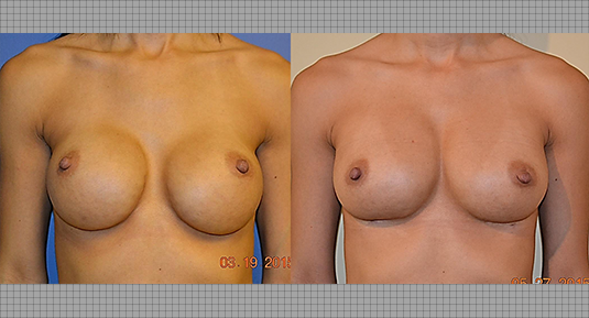 Breast Lift Before and After Photo by Andrew Kornstein MD in New York City, NY
