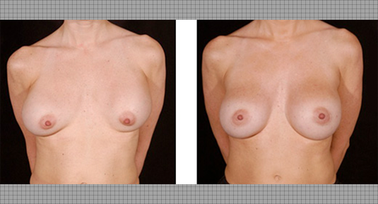 Breast Lift Before and After Photo by Andrew Kornstein MD in New York City, NY