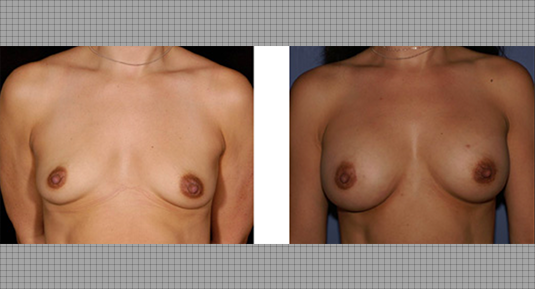 Breast Lift Before and After Photo by Andrew Kornstein MD in Greenwich, CT and White Plains, NY.