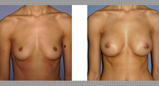 Breast Lift Before and After Photo by Andrew Kornstein MD in Greenwich, CT and White Plains, NY.
